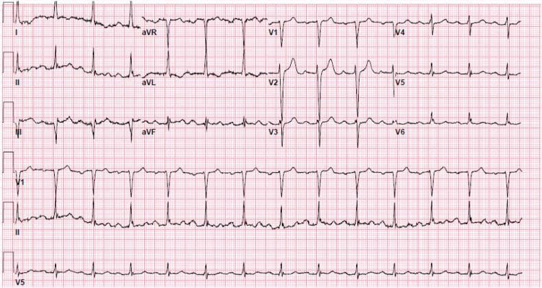 This diagnostic image is a 12-lead electrocardiogram (ECG) printed on standard pink grid paper, presenting a 10-second rhythm strip at the bottom for leads V1, II, and V5. The ECG demonstrates a regular sinus rhythm characterized by the presence of a P wave before every QRS complex, with P waves upright in leads I, II, and aVF. The primary diagnostic finding is a first-degree atrioventricular (AV) block, indicated by a consistently prolonged PR interval exceeding 200 milliseconds (5 small squares) throughout all leads. The QRS complexes are narrow and appear to have normal morphology and axis. No acute ST-segment elevations or depressions are visible, and T waves are generally upright and concordant with the QRS complexes, though baseline noise is present in some leads. This tracing is a classic educational example used to illustrate delayed conduction through the AV node while maintaining a 1:1 relationship between atrial and ventricular depolarization.