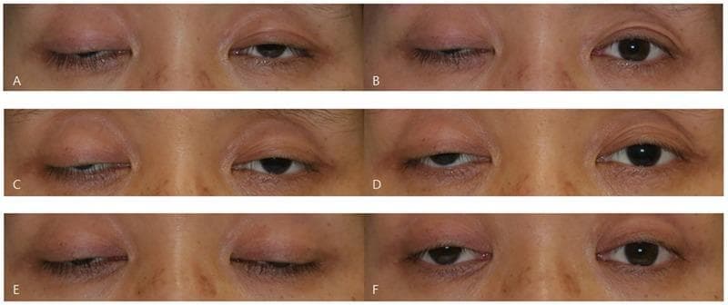 This set of six clinical photographs (A-F) illustrates the variability of the ice test in a patient with myasthenia gravis presenting with bilateral asymmetric ptosis. The images are arranged in pairs representing three different days, showing the patient's eyes before and after a 2-minute ice application. Frames A, C, and E show baseline bilateral blepharoptosis with varying degrees of upper eyelid drooping obscuring the pupil and iris. Frames B, D, and F show the post-intervention state. The series demonstrates three distinct clinical responses in the right eye: (B) a negative result with no significant change, (D) an equivocal result showing subtle 1.0 mm elevation, and (F) a positive result with a marked 2.0 mm increase in the palpebral fissure. This comparison serves as an educational tool for neurology and ophthalmology students to understand the fluctuating nature of neuromuscular junction disorders and the diagnostic utility (and inconsistency) of the ice pack test, which temporarily improves ptosis by inhibiting acetylcholinesterase at the motor endplate.