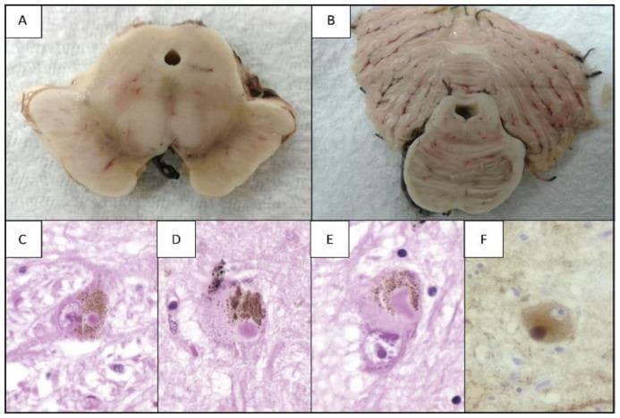 This composite image illustrates the macroscopic and microscopic histopathological hallmarks of Parkinson's Disease (PD) across different brain regions. Panels A and B present gross cross-sections of the midbrain and pons, respectively. Panel A demonstrates characteristic depigmentation of the substantia nigra and a dilated cerebral aqueduct. Panel B shows slight depigmentation of the locus ceruleus. Panels C, D, and E provide light microscopy views (Hematoxylin and Eosin, 1000x magnification) of dopaminergic neurons in the substantia nigra. These sections highlight neuromelanin pigment and the presence of classical Lewy bodies—circular, eosinophilic (pink) intracytoplasmic inclusions that displace the nucleus. Panel F shows a similar neuron processed with immunohistochemistry using anti-alpha-synuclein antibodies (1000x magnification), revealing a brown-stained Lewy body that confirms the protein's presence within the inclusion. This collection serves as an educational reference for understanding neurodegeneration and protein aggregation in synucleinopathies.