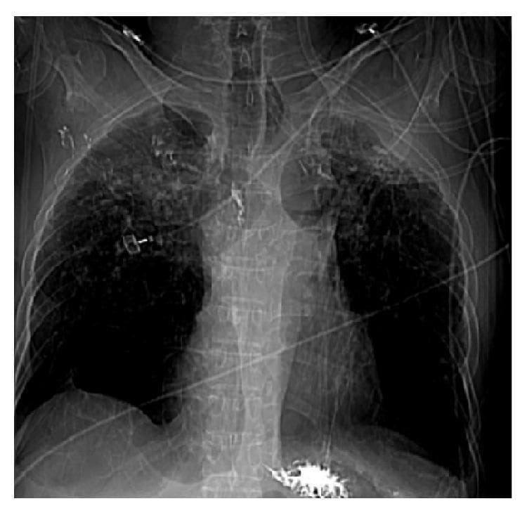 A frontal chest X-ray (CXR) demonstrating advanced pulmonary sarcoidosis manifestations. The upper lung fields bilaterally show extensive fibrocalcific scarring, characterized by dense, irregular, and mottled opacities consistent with stage IV sarcoidosis. There is significant volume loss in the upper lobes with superior retraction of the hila. In contrast, the lower lung zones exhibit increased lucency and hyperinflation, indicative of compensatory emphysema. Multiple medical devices are visible, including an endotracheal tube, enteric tube, and various monitoring leads and external cables, consistent with an intensive care clinical setting. The mediastinal contour appears distorted due to chronic fibrotic retraction. This image illustrates the end-stage progression of granulomatous lung disease, highlighting the transition from parenchymal inflammation to permanent structural fibrosis and secondary airflow obstruction.