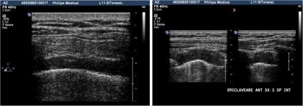 This diagnostic image consists of two thoracic ultrasound panels illustrating various forms of pleural pathology. The left panel shows a B-mode ultrasound scan of the pleura in a patient with asbestosis. It demonstrates focal pleural thickening characterized by a well-demarcated hypo-anechoic area that creates a 'doubling' of the pleural line. This represents a classic pleural plaque. The right panel displays two side-by-side scans (transverse and longitudinal views) of a more advanced pleural lesion. This plaque exhibits loss of the distinct tissue interface and shows direct infiltration into the adjacent chest wall muscle layers, evidenced by the disruption of normal muscular bands. In a clinical context, such infiltrative behavior is a critical sonographic sign suggestive of neoplastic transformation, such as malignant mesothelioma. These images are essential for medical students and radiologists in learning to differentiate benign asbestos-related plaques from malignant pleural disease using high-frequency linear probes.