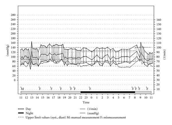 This Comparison Chart displays a 24-hour ambulatory blood pressure (ABP) recording, typically used to evaluate circadian blood pressure patterns in clinical cardiology and neurology. The x-axis represents a 24-hour timeline from 11:00 to 11:00, with horizontal bars at the bottom indicating 'Day' (white) and 'Night' (black) periods. The primary y-axis (left) measures blood pressure in mmHg (0–280), and the secondary y-axis (right) measures heart rate or flow rate in l/min (10–160). The graph plots systolic and diastolic blood pressure fluctuations throughout the day and night. Dashed horizontal lines indicate clinical upper limit thresholds for hypertension diagnosis. A key educational feature is the 'non-dipping' profile, where the expected 10–20% nocturnal decrease in blood pressure is absent, a common finding in patients with autonomic dysfunction, such as those with Parkinson's disease. The chart also contains annotations for 'M' (manual measurement) and 'F' (mismeasurement), illustrating the data cleaning process in diagnostic monitoring.