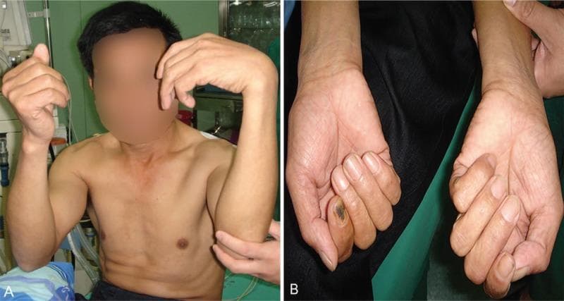 Clinical photograph of a 50-year-old male presenting with multi-nerve palsy of the left upper limb involving the radial, median, and ulnar nerves. Panel A shows a side-by-side comparison of the upper extremities; the left hand exhibits a characteristic 'wrist drop' and 'claw-shaped hand' deformity due to extensor and intrinsic muscle weakness. Panel B provides a close-up comparative view of the palmar surfaces. The left hand (right of image) demonstrates significant muscle atrophy, particularly in the thenar and hypothenar eminences, alongside flattening of the forearm flexor group. This visual evidence highlights the motor consequences of prolonged compression (Saturday night palsy/autogenous compression), demonstrating the classic postural signs of combined peripheral nerve injury in the hand and wrist.