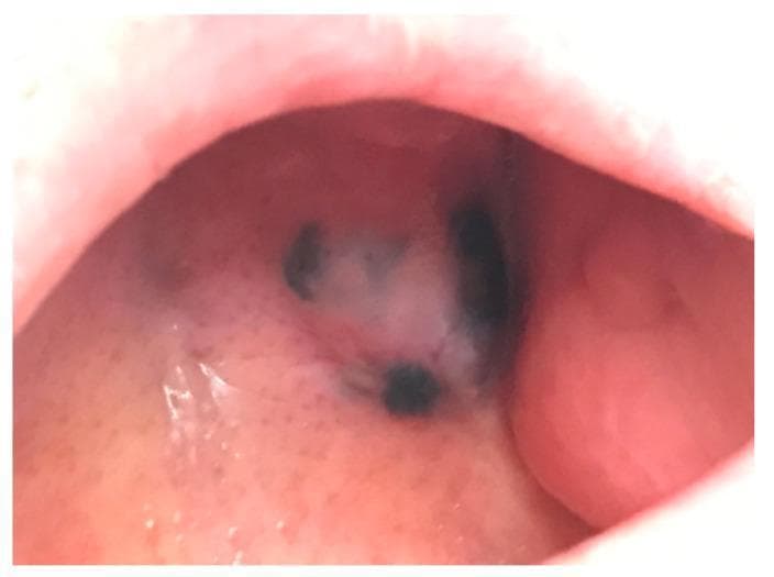 This clinical photograph shows a case of oral mucosal melanoma, an aggressive pigmented neoplasm. The image displays a large, irregular nodular lesion located on the mucosal surface of the oral cavity, likely involving the hard palate or alveolar ridge. The lesion is characterized by heterogenous pigmentation, featuring deep black to dark-brown areas interspersed with focal regions of depigmentation or amelanotic tissue. The borders of the lesion are poorly defined and asymmetric, which is a hallmark of malignancy. The surface appears slightly elevated and nodular with an irregular texture. This visual serves as an educational example of mucosal melanoma's presentation, highlighting the importance of inspecting oral pigmentation for signs of asymmetry, color variation, and nodularity. It is relevant for dental and dermatological oncology, emphasizing the distinction between benign melanotic macules and malignant mucosal lesions.