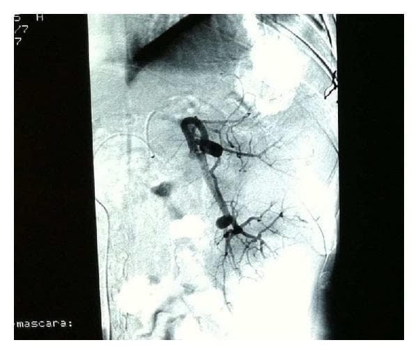This diagnostic image is a splenic arteriogram (angiography) demonstrating the vascular anatomy of the spleen. The primary splenic artery is opacified with iodinated contrast, appearing as a thick, tortuous vessel originating from the celiac trunk. As it approaches the splenic hilum, it divides into multiple secondary and tertiary segmental branches that radiate into the splenic parenchyma. The vessels exhibit a normal tapering morphology toward the periphery, indicating distal perfusion. The image captures the vascular distribution prior to or during a partial splenic embolization procedure, a technique used in interventional radiology to manage hypersplenism or portal hypertension. The contrast-enhanced arterial tree is clearly visible against the radiolucent background, providing a detailed map of the hilar and intra-parenchymal blood supply essential for superselective catheterization.