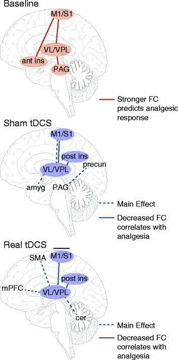 A comparative anatomical diagram of the human brain illustrating functional connectivity (FC) changes in patients with fibromyalgia across three conditions: Baseline, Sham transcranial Direct Current Stimulation (tDCS), and Real tDCS. The diagrams utilize sagittal brain outlines to map regions of interest including the primary motor/somatosensory cortex (M1/S1), thalamic nuclei (VL/VPL), anterior/posterior insula (ant/post ins), periaqueductal gray (PAG), amygdala (amyg), and cerebellum (cer). At baseline, red solid lines indicate that stronger FC between M1/S1, VL/VPL, ant ins, and PAG predicts a better analgesic response. Under the Sham tDCS condition, dashed blue lines represent a main effect of connectivity changes, while solid blue lines show decreased FC correlating with analgesia between the thalamus and posterior insula/M1. In the Real tDCS condition, distinct pathways of decreased FC are shown between the VL/VPL thalamus and the medial prefrontal cortex (mPFC), supplementary motor area (SMA), and cerebellum, highlighting the neural mechanisms of neuromodulation-induced pain relief.