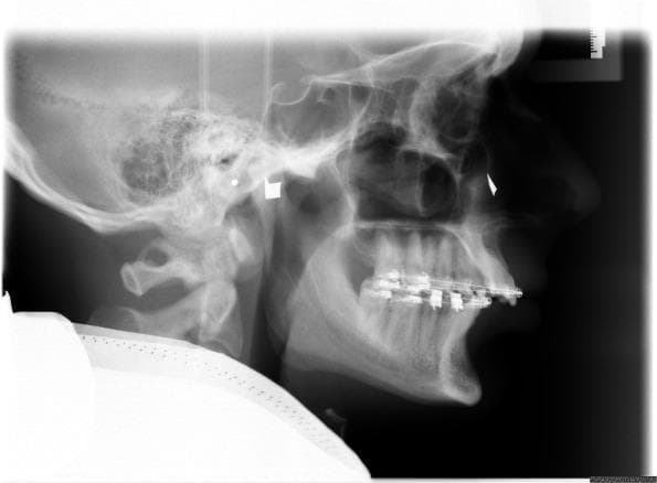 A lateral cephalometric radiograph of a human skull, primarily used in orthodontics and orthognathic surgery planning. Key visible anatomical structures include the cranium, maxilla, mandible, cervical vertebrae (C1-C2), and the nasal and orbital cavities. Radiopaque orthodontic appliances, including brackets and archwires, are visible on both the maxillary and mandibular teeth, indicating active dental treatment. Two distinct artificial metal markers are present on the patient's skin to assist in clinical localization: a square marker positioned near the individual hinge axis (pre-auricular area) and a triangular marker located over the right infraorbital rim. These markers serve as reference points for determining the axis-orbital plane (AOP). The soft tissue profile is clearly outlined, allowing for analysis of facial aesthetics in relation to underlying skeletal structures. This imaging is essential for calculating cephalometric angles and distances required for virtual surgical simulation and mounting in a digital articulator.