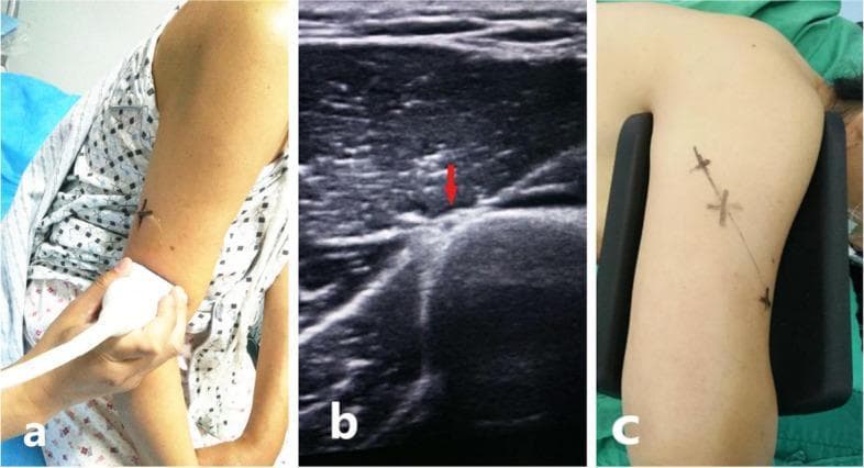 This composite of three panels (a, b, and c) illustrates the preoperative ultrasound-guided localization of the radial nerve in the posterior upper arm, typically performed before surgical management of a humeral shaft fracture. Panel (a) shows a clinical photograph of a high-resolution linear ultrasound transducer being applied to the posterior aspect of the mid-humerus in a seated patient. Panel (b) presents a grayscale ultrasound (US) image in the transverse plane, where a red arrow identifies the radial nerve as a distinct hypoechoic, oval structure situated in the spiral groove between the triceps muscle bellies and the hyperechoic humeral cortex. Panel (c) displays the final clinical result, with the anatomical course of the radial nerve demarcated on the patient's skin using surgical marker 'X' annotations connected by a line. This technique aims to facilitate safer surgical exposure and reduce the risk of iatrogenic radial nerve injury during orthopedic procedures like open reduction and internal fixation (ORIF).