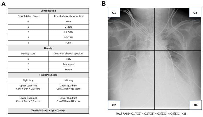 This medical infographic and diagnostic image set illustrates the Radiographic Assessment of Lung Edema (RALE) scoring system used in the context of Acute Respiratory Distress Syndrome (ARDS). Panel A provides a structured reference table for calculating scores based on two criteria: Consolidation and Density. Consolidation is scored from 0 to 4 based on the percentage of lung area involved (none to >75%), while Density is scored from 1 to 3 (hazy, moderate, or dense). The final RALE score is the sum of products (Consolidation × Density) across four quadrants. Panel B demonstrates the practical application of this system on a bedside chest X-ray (CXR) showing bilateral alveolar opacities and medical lines/tubes. The CXR is divided into four quadrants (Q1-Q4) by a vertical midline and a horizontal line at the level of the first branch of the left main bronchus. An example calculation shows a total RALE score of 25, derived from specific quadrant scores. This content is intended for critical care and radiology training to standardize the semi-quantitative assessment of pulmonary edema and inflammation severity.