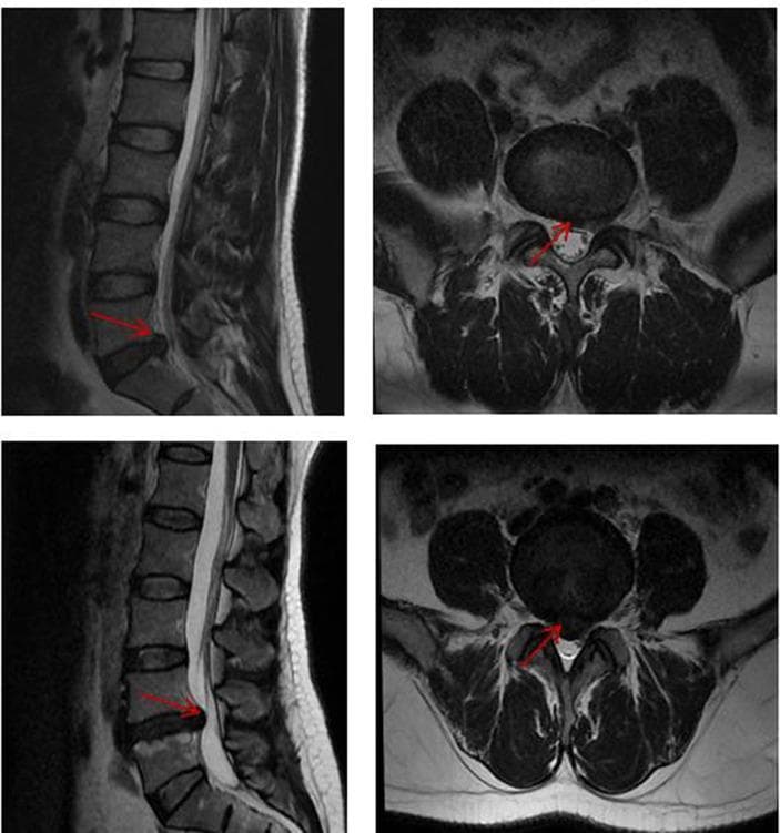 This diagnostic image displays four T2-weighted magnetic resonance imaging (MRI) views of the lumbar spine, specifically highlighting Lumbar Disc Herniation with Chronic Pain (LDHCP). The left panels show sagittal sections where the lumbar vertebrae and intervertebral discs are visible. Red arrows point to posterior disc protrusions at the L4-L5 or L5-S1 levels, demonstrating a loss of disc height and focal extrusion of nuclear material into the spinal canal. The right panels provide axial cross-sections at the level of the herniation. These views clearly show the herniated disc material (red arrows) compressing the thecal sac and narrowing the available space for the cauda equina nerve roots. The surrounding paraspinal musculature and facet joints are also visible. This imaging is characteristic of radiculopathy and chronic low back pain syndromes, used clinically to correlate structural spinal pathology with neurological symptoms and functional impairment.