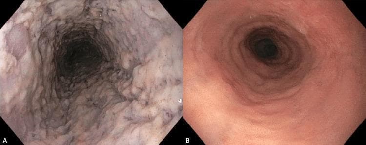 This side-by-side comparison displays two endoscopic images of the esophagus, illustrating a case of esophageal candidiasis before and after antifungal treatment. Image A is a clinical photograph from an upper gastrointestinal endoscopy showing severe esophageal candidiasis. The esophageal mucosa is extensively covered by thick, confluent, white-to-creamy plaques that give the lumen a shaggy and irregular appearance. These plaques cause apparent luminal narrowing and signify a fungal infection, commonly Candida albicans, often associated with immunocompromised states or corticosteroid use. Image B shows the same anatomical region 12 weeks following fluconazole therapy. The mucosa has returned to a healthy state, characterized by a smooth, glistening texture and a uniform pinkish-red color without evidence of exudates or plaques. The esophageal lumen appears patent and unobstructed. This comparison serves as an educational tool for identifying the classic endoscopic presentation of fungal esophagitis and the visual evidence of therapeutic resolution.