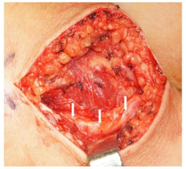 This clinical photograph shows an intraoperative view of an open surgical site on the lateral aspect of a right leg, specifically at the level of the fibular head. The incision is retracted to reveal the underlying anatomy of the peripheral nervous system. White arrows point to the common peroneal nerve (CPN) following a distal release or neurolysis procedure. The nerve appears as a pale, whitish-yellow cord-like structure positioned superficially within the surgical field. Surrounding tissues visible include the subcutaneous adipose layer (yellow, lobulated), deep fascia, and red muscle fibers. The popliteal fossa is oriented to the right of the image, while the calf region extends to the left. The image serves as an educational resource for identifying the common peroneal nerve's path as it wraps around the fibular head and for understanding surgical decompression techniques used to treat nerve entrapment.