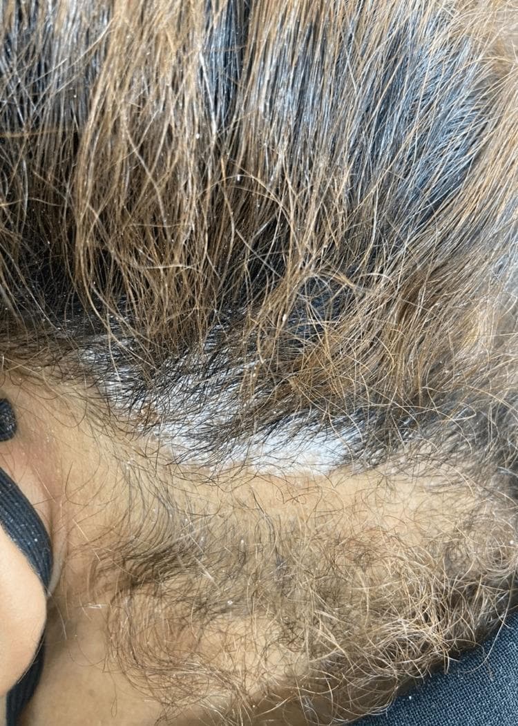 This clinical photograph shows a close-up view of a patient's scalp, demonstrating hallmark signs of scalp psoriasis. The image reveals multiple well-circumscribed, erythematous plaques covered by thick, micaceous (silvery-white) scales. These scales are non-uniformly distributed across the scalp and appear heavily concentrated at the base of the hair follicles. Many scales have detached from the skin surface and are visible clinging to individual hair shafts, creating a characteristic flaky or 'powdery' texture throughout the surrounding hair. The presentation is typical for chronic plaque psoriasis affecting the scalp, specifically in the context of paradoxical reactions or drug-induced dermatoses. Key educational features include the contrast between the silvery scales and the underlying skin, the focal density of the plaques, and the typical involvement of the hair-bearing areas without resulting in primary scarring alopecia.