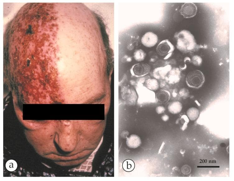 This composite educational image illustrates the clinical and microscopic features of shingles (Herpes Zoster). Panel (a) is a clinical photograph of an elderly patient demonstrating a classic unilateral vesicular rash. The lesions follow a specific dermatomal distribution on the right side of the scalp and forehead, sharply demarcated at the midline. The skin shows confluent erythematous plaques with clustered vesicles and areas of crusting, characteristic of a reactivated Varicella-Zoster Virus (VZV) infection. Panel (b) is a negative-stain electron micrograph (DEM) of fluid collected from a vesicle. It reveals an aggregate of herpesvirus particles. The virions exhibit typical morphology: a 110 nm icosahedral capsid core surrounded by a protein tegument and a loose outer envelope, totaling approximately 150-180 nm in diameter. Some capsids appear dark or 'empty' due to PTA-stain penetration. The presence of these spherical particles alongside cellular detritus confirms the diagnosis. A 200 nm scale bar is provided for size reference. This material is designed for dermatology and infectious disease studies.