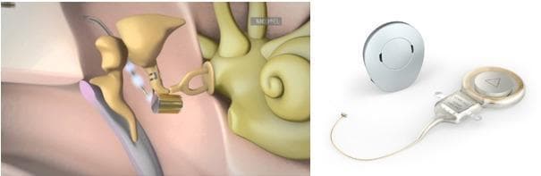 This medical illustration depicts the components and anatomical placement of the Vibrant Soundbridge (VSB), a partially implantable active middle ear implant system. The image is divided into two panels. The left panel shows a cross-sectional anatomical diagram of the middle and inner ear. It illustrates the internal Vibrant Ossicular Prosthesis (VORP) with its Floating Mass Transducer (FMT) attached to the long process of the incus. The FMT is positioned to deliver mechanical vibrations to the ossicular chain (malleus, incus, and stapes), which then transmits sound to the cochlea. The right panel displays the hardware components: the external, circular audio processor—which contains the microphone and battery—and the internal receiver unit featuring a metallic coil and a connector lead. This system is designed for patients with conductive, sensorineural, or mixed hearing loss by bypassing damaged outer or middle ear structures through direct electromechanical stimulation of the ossicles.