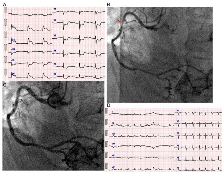 This composite medical image illustrates a clinical case of variant angina. Panel A shows an initial 12-lead electrocardiogram (ECG) with significant ST-segment elevation in the inferior leads (II, III, aVF) and an escape rhythm, indicative of acute inferior myocardial ischemia. Panel B is a coronary angiogram of the right coronary artery (RCA) showing a focal, severe stenosis in the proximal segment (indicated by a red arrow) caused by coronary vasospasm. Panel C shows the same RCA after the administration of intracoronary nitroglycerin, demonstrating the complete resolution of the stenosis and restoration of normal vessel diameter. Panel D shows a follow-up ECG with the resolution of the ST-segment elevation in leads II, III, and aVF, now displaying atrial fibrillation. The set of images effectively demonstrates the diagnostic hallmarks of variant (Prinzmetal) angina: reversible ST-elevation on ECG associated with angiographic evidence of coronary artery spasm that responds to vasodilators.