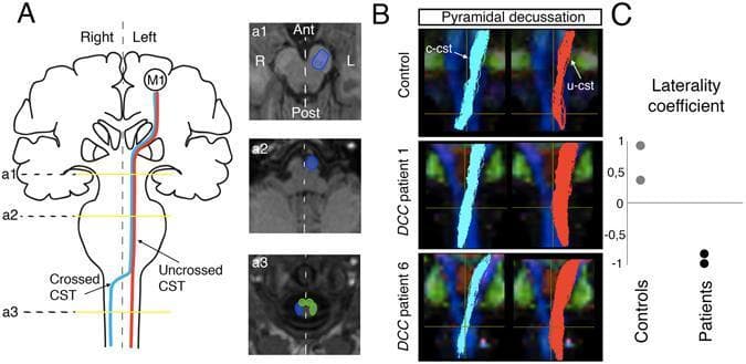 Educational medical graphic illustrating the tractography of the corticospinal tract (CST) in healthy controls and patients with DCC-related congenital mirror movements (DCC-CMM). Panel A provides an anatomical schematic and axial MR slices identifying Regions of Interest (ROIs) for fiber reconstruction: the base of the pons (a1), the anterior pyramid in the upper medulla (a2), and the cervical cord funiculus (a3). Crossed fibers are color-coded in light blue, and uncrossed fibers in red. Panel B displays coronal tractography at the level of the pyramidal decussation, superimposed on fractional anisotropy maps. It contrasts a healthy control, showing dominant light blue crossed CST (c-cst) fibers, with two DCC-CMM patients exhibiting a marked increase in red uncrossed CST (u-cst) fibers. Panel C presents a laterality coefficient graph, where controls show positive values (predominantly crossed fibers) and DCC patients show negative values (predominantly uncrossed fibers), highlighting the failure of normal axonal midline crossing in this condition.