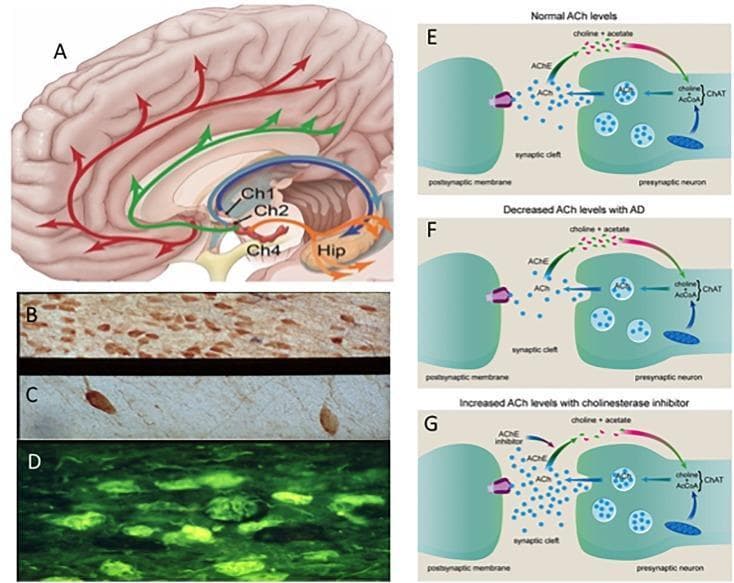 A multi-panel educational composite illustrating the cholinergic system in health and Alzheimer’s Disease (AD). (A) Sagittal anatomical diagram of the human brain showing cholinotrophic projection systems from cholinergic cell groups Ch1 (medial septal), Ch2 (diagonal band), and Ch4 (nucleus basalis) to the neocortex and hippocampus (Hip). (B-D) Photomicrographs comparing basal forebrain neurons: (B) healthy aged control with high neuron density; (C) AD sample showing significant neuronal loss and atrophy; (D) Thioflavin-S fluorescent staining identifying neurofibrillary tangles in p75NTR neurons. (E-G) Pathophysiology diagrams of the cholinergic synapse: (E) normal acetylcholine (ACh) synthesis via ChAT and degradation via AChE; (F) reduced ACh levels typical of AD pathology; and (G) the therapeutic mechanism of acetylcholinesterase inhibitors (AChEIs), which block AChE to increase synaptic ACh availability. The content highlights the neuroanatomical basis, histopathological changes, and pharmacological interventions relevant to dementia and neurodegeneration.