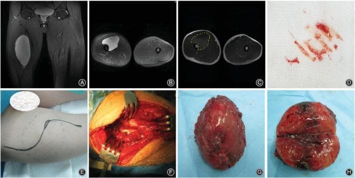 This composite figure illustrates the clinical management and pathology of a primary myxoid liposarcoma in the left thigh of a 20-year-old male. (A-C) Diagnostic MRI in coronal and axial planes shows a large, hyperintense, well-circumscribed ovoid mass within the medial muscle compartment. A yellow dotted line in (C) indicates the planned surgical margins. (D) A biopsy sample on gauze confirms the preoperative diagnosis. (E-F) Surgical progression images depict the planned incision incorporating the biopsy site and the intraoperative field where periosteal resection was performed near the bone. (G-H) Macroscopic pathology of the resected specimen reveals a smooth, glistening, reddish-brown encapsulated mass. Longitudinal sectioning (H) demonstrates a heterogeneous internal architecture with prominent dark regions of central necrosis and cystic degeneration, characteristic of high-grade components or typical evolution of large liposarcomas. The sequence highlights the workflow from diagnostic radiology and biopsy to wide surgical excision and gross pathological assessment in musculoskeletal oncology.
