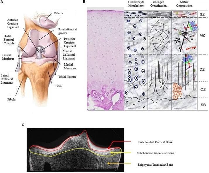 A multi-panel educational figure illustrating the macro and micro-anatomical structures of the human knee joint and articular cartilage.
Panel A is an anatomical diagram of the right knee joint in an anterior view, highlighting skeletal and ligamentous structures including the femur (distal femoral condyle), tibia, fibula, and patella. Key ligaments shown include the anterior and posterior cruciate ligaments, and the medial and lateral collateral ligaments, along with the medial and lateral menisci and the patellofemoral groove.
Panel B provides a histological and schematic cross-section of hyaline articular cartilage organized into four zones: Superficial (SZ), Middle (MZ), Deep (DZ), and Calcified (CZ), transitioning to Subchondral Bone (SB). It details variations in chondrocyte morphology (flattened to columnar), collagen orientation (tangential to vertical), and extracellular matrix composition across these layers.
Panel C is a diagnostic radiographic image (CT/X-ray) of the tibial plateau, segmenting the subchondral bone into three regions: the subchondral cortical bone (end-plate), subchondral trabecular bone, and epiphyseal trabecular bone. This figure serves as a comprehensive reference for orthopedic anatomy and cartilage pathophysiology.