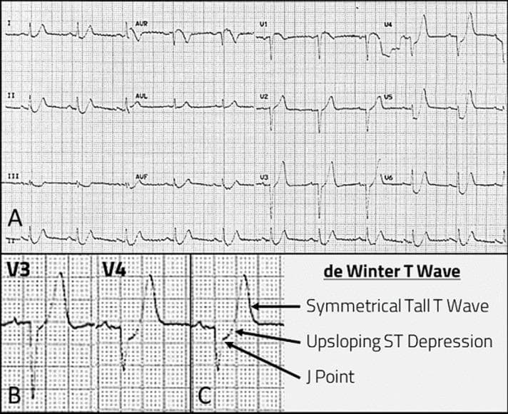This diagnostic image displays a three-panel montage of a 12-lead electrocardiogram (ECG) demonstrating the 'de Winter T-wave' pattern, a classic STEMI-equivalent sign indicative of proximal left anterior descending (LAD) coronary artery occlusion. Panel A shows a standard 12-lead ECG tracing during an episode of acute chest pain, highlighting abnormalities in the precordial leads. Panels B and C provide magnified views and annotations of leads V3 and V4 to illustrate specific diagnostic criteria. Key features identified include: 1) J-point depression of 1-3 mm, 2) an upsloping ST-segment depression that transitions directly into 3) tall, prominent, and symmetrical T-waves. These findings are most prominent in the precordial leads (V1-V6). The educational focus is on the recognition of high-risk ischemic ECG patterns that do not manifest as classic ST-segment elevation but represent acute myocardial infarction. This resource is intended for emergency medicine and cardiology learners to differentiate de Winter T-waves from other causes of tall T-waves, such as hyperkalemia.