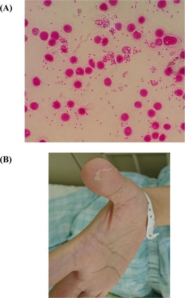 The composite image contains two panels relevant to a clinical case of sepsis. (A) Light microscopy (Gram stain, 1000x magnification) of a blood culture smear. It shows numerous small, pink-stained, Gram-negative rod-shaped bacteria (coccobacilli) scattered individually and in clusters among circular pink-stained host cells, characteristic of Yersinia pseudotuberculosis. (B) A clinical photograph of a patient's hand demonstrating distal cutaneous desquamation. The thumb displays characteristic peeling and flaking of the superficial epidermis, revealing raw, erythematous underlying skin at the fingertip. This visual finding is a classic clinical sign of Far East scarlet-like fever (FESLF) or toxic shock-like syndromes. Collectively, these images illustrate the diagnostic progression from microbiological identification of a pathogen to the manifestation of dermatological sequelae in systemic infection.