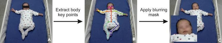 This clinical flow diagram illustrates a digital pseudonymization and movement analysis procedure for infants. The sequence is divided into three stages: (A) Original clinical photograph of an infant in a supine position, with a black bar obscuring the eyes for initial privacy. (B) Body key point extraction using OpenPose software, showing a multi-colored skeletal overlay that maps anatomical landmarks including joints, limbs, and facial features (eyes and nose). (C) Automated de-identification where a blurring mask is applied to the facial region, specifically targeting the ocular and nasal areas to preserve anonymity while maintaining the visibility of the rest of the body. An inset magnification highlights the efficacy of the facial blurring mask. This process is relevant for pediatric research and diagnostic neurology, specifically in the automated classification of 'fidgety movements' (FM) to assess neurodevelopmental risks without compromising patient privacy.
