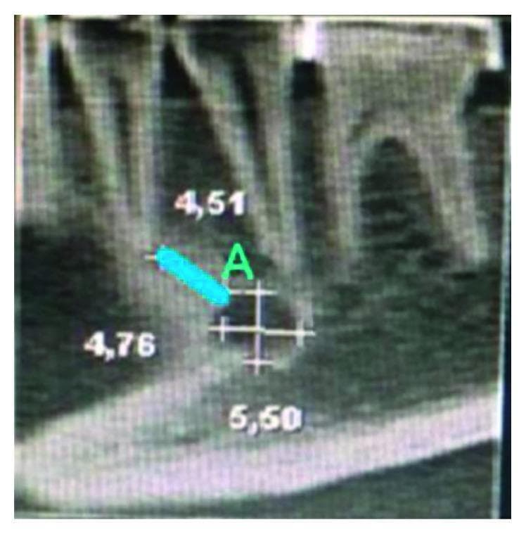 This diagnostic image shows a sagittal view of the human mandible, likely obtained via Cone Beam Computed Tomography (CBCT). The image focuses on the mandibular anatomy and the spatial relationship between the dental roots and the mental foramen (MF). Several lower teeth are visible, characterized by their radiopaque enamel and dentin, with roots extending into the alveolar bone. The mental foramen is identified as a well-defined, ovoid radiolucent area located inferior to the premolar root apices. Quantitative analysis is superimposed on the image: a blue line labeled 'A' measures the vertical distance from the superior cortical border of the mental foramen to the apex of the adjacent tooth root. Numerical annotations (4.51, 4.76, and 5.50) indicate precise morphometric measurements in millimeters for height, length, and distance to anatomical landmarks. This visual is intended for dental and maxillofacial education, specifically regarding preoperative planning for implants or local anesthesia to avoid neurovascular injury.
