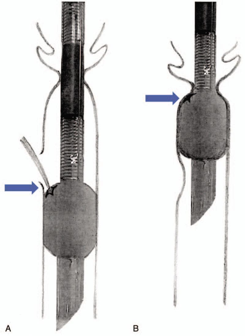 This medical illustration presents a comparison between two electromyogram (EMG) endotracheal tubes, labeled A and B, within a schematic representation of the trachea and vocal cords. The primary focus is the integrity of the inflatable cuff and its interaction with anatomical structures during extubation. Both tubes feature a spiral-reinforced main body with integrated electrodes for laryngeal nerve monitoring. Panel A illustrates a torn silicone cuff (indicated by a blue arrow and star) with a visible protrusion through the rupture. This diagram demonstrates a clinical complication where the vocal cords obstruct the tear site, preventing air from escaping and causing the cuff to remain spontaneously inflated despite deflation attempts. Panel B shows an intact, inflated cylindrical cuff positioned below the vocal cords for comparison. The illustration highlights the unique elastic properties of silicone EMG tube cuffs, which may retain their shape even when damaged, posing risks for traumatic extubation if the vocal cords catch on the irregular surface or prevent collapse. Key concepts include airway management, intraoperative neuromonitoring, and mechanical complications of reinforced endotracheal tubes.