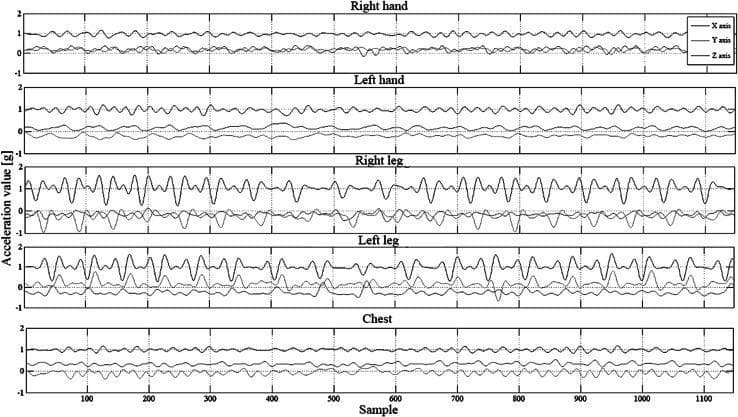 This Comparison Chart displays triaxial acceleration signals recorded for clinical assessment, likely in the context of movement disorders such as Parkinson’s disease. The figure presents five stacked time-series plots corresponding to different anatomical regions: Right hand, Left hand, Right leg, Left leg, and Chest. Each plot tracks acceleration values (measured in g) across X, Y, and Z axes against a sample timeline (0 to 1100 samples).
Key visual features include:
- Hand Signals: Characterized by relatively low-amplitude, stable oscillations, indicating smoother movement patterns.
- Leg Signals: Demonstrate significantly higher amplitude fluctuations and increased frequency, particularly in the X-axis, representing more dynamic or irregular gait and limb acceleration.
- Chest Signals: Show the most stable, low-amplitude patterns across all three axes, reflecting central body mass stability during activity.
This data is used in neurology and rehabilitation medicine to objectively quantify motor symptoms (e.g., tremor, bradykinesia, or gait disturbances) using wearable sensors. It supports automated symptom recognition and condition monitoring through algorithmic analysis of movement symmetry and intensity.