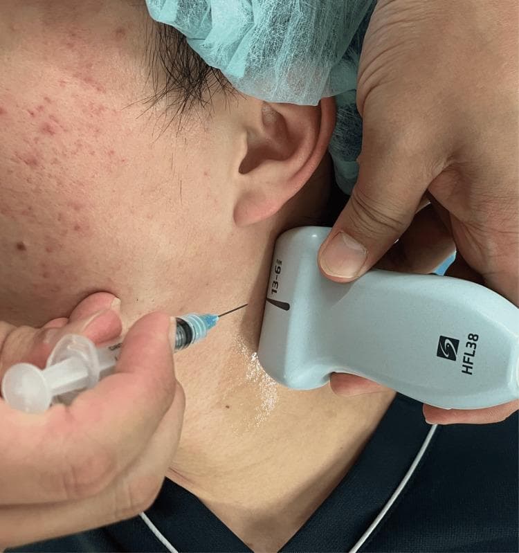 This clinical procedural photograph demonstrates an ultrasound-guided selective glossopharyngeal nerve block (UGSGNB). The image shows a high-frequency linear ultrasound probe (model HFL38, labeled 13-6 MHz) positioned in a transverse orientation on the upper lateral neck, just inferior to the earlobe and posterior to the mandible. A thin needle, attached to a transparent syringe with a blue hub, is being inserted into the submandibular/upper cervical region using an in-plane technique. The needle's trajectory is directed toward the deep cervical fascia beneath the probe's footprint, where clear ultrasound gel has been applied for acoustic coupling. The procedure is aimed at delivering local anesthetic (e.g., ropivacaine) near the styloid process and stylohyoid muscle to achieve neural blockade. This educational visual is relevant for anesthesiology and pain management training, highlighting probe placement and needle approach for regional anesthesia of the head and neck.