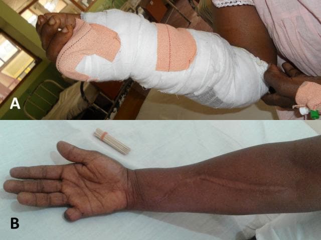 Clinical photograph comparison (Images A and B) demonstrating the acute management and long-term musculoskeletal outcomes of a hump-nosed viper bite. Image A shows a patient's right forearm and hand in the acute phase, heavily encased in white gauze and compression bandages extending from the mid-forearm to the digits, following an emergency decompression fasciotomy for compartment syndrome. Image B displays the same limb four years post-injury. Key visible features include a prominent, linear, longitudinal surgical scar along the volar aspect of the forearm, consistent with a healed fasciotomy. Additionally, the right fifth digit (small finger) shows partial amputation of the distal and middle phalanxes, a consequence of localized necrosis from the envenomation. This comparison highlights the potential for permanent musculoskeletal sequelae, such as tissue loss and scarring, following severe necrotic snakebite envenoming and its surgical management.