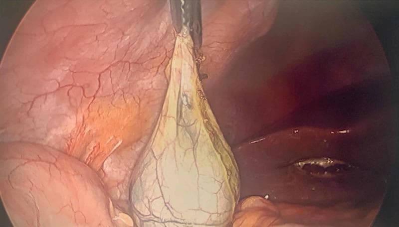 This clinical photograph shows an intraoperative laparoscopic view during a cholecystectomy. The primary focus is the gallbladder, which appears as a pear-shaped, pale yellow-to-cream sac. The serosal surface of the gallbladder exhibits a visible network of fine vascularization. An atraumatic laparoscopic grasper is securely attached to the neck or cystic duct region, elevating the gallbladder to facilitate extraction from the abdominal cavity. Surrounding anatomical structures include the liver, visible as a dark reddish-brown organ on the right with a small surgical site or defect, and the abdominal wall or adjacent viscera on the left, displaying prominent subserosal blood vessels. The image demonstrates a critical step in surgical technique: the manipulation and securing of the specimen prior to removal through a port site. This visual serves as an educational resource for general surgery, illustrating laparoscopic biliary anatomy and instrument placement.