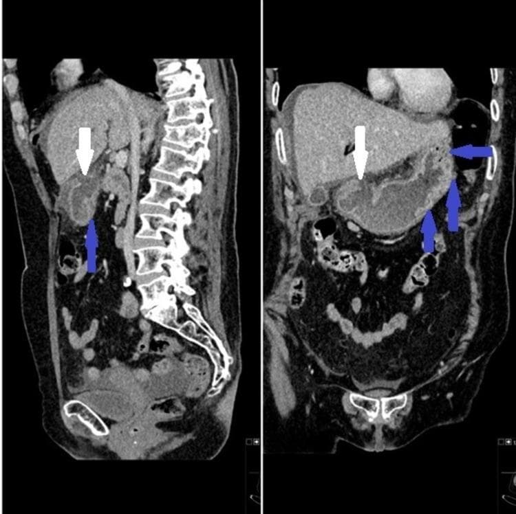 This diagnostic image displays Computed Tomography (CT) scans of the abdomen in sagittal (left) and coronal (right) reformatted views, illustrating a perforated peptic ulcer. The primary pathology is a focal defect in the gastric wall, indicated by a white arrow, representing the site of perforation. Surrounding the defect, there is significant thickening and increased density of the gastric wall, marked by blue arrows, which is characteristic of inflammatory wall edema. Anatomical landmarks include the liver situated superiorly, the vertebral column visible posteriorly in the sagittal plane, and the stomach centrally located. These multi-planar reconstructions are clinically significant for identifying the exact anatomical site of bowel perforation and assessing secondary signs like localized inflammation. The content is suitable for medical education focusing on gastroenterology, radiology, and emergency surgical diagnosis of acute abdominal conditions.