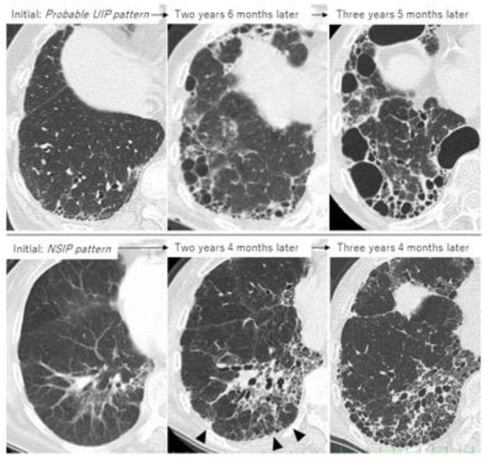 High-resolution computed tomography (HRCT) axial scans of the lung illustrating the progression of Rheumatoid Arthritis-associated Interstitial Lung Disease (RA-ILD) over approximately 3.5 years in two distinct radiographic patterns. The upper row demonstrates a 'Probable Usual Interstitial Pneumonia (UIP)' pattern. Initial scans show baseline reticulation and small subpleural cystic spaces, which progress at the 2-year 6-month and 3-year 5-month marks into extensive, multi-layered honeycombing with significant architectural distortion. The lower row displays a 'Nonspecific Interstitial Pneumonia (NSIP)' pattern. The initial scan shows ground-glass opacities and mild reticulation. Over 3 years and 4 months, there is a transformation into a UIP-like phenotype, characterized by the development of subpleural reticulation, traction bronchiectasis (indicated by arrowheads), and localized peripheral honeycombing. This comparison highlights the natural history of fibrotic progression and the phenotypic 'drift' toward a UIP-like pattern in chronic connective tissue disease-associated ILD, carrying significant prognostic and therapeutic implications.