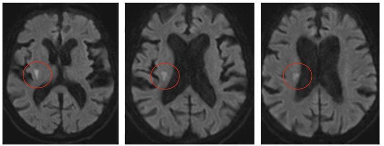 Diagnostic Image: Three axial slices of a Diffusion-Weighted Imaging (DWI) MRI sequence of the brain. The images demonstrate an acute ischemic infarct located in the right hemisphere, highlighted by red circles. The lesion appears as a focal area of hyperintensity, signifying restricted diffusion. Anatomically, the infarct originates in the right basal ganglia and extends superiorly through the subcortical white matter into the corona radiata. The middle and superior slices show the lesion lateral to the lateral ventricles, which appear enlarged, possibly due to age-related atrophy. The hyperintense region has an irregular morphology that is contiguous across the sequential slices. This clinical finding is diagnostic of an acute stroke in the middle cerebral artery territory, demonstrating the typical presentation of restricted diffusion in early ischemia.