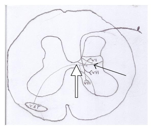 Anatomical diagram of a spinal cord cross-section illustrating the pathway of the ventral spinothalamic tract (VST). The illustration depicts the central H-shaped gray matter and surrounding white matter. Key structures labeled include Rexed laminae VI, VII, and VIII in the dorsal and intermediate horns of the gray matter. A black arrow indicates the origin of secondary sensory neurons within these deep laminae. A white arrow tracks the decussation (crossing over) of these nerve fibers through the anterior white commissure to the contralateral side. The fibers terminate in the ventral white column, labeled as the 'VST' tract. This diagram serves as a neuroanatomical representation of the ascending somatosensory pathway for crude touch and pressure, highlighting its origin in non-opioid-rich Rexed layers compared to the lateral spinothalamic tract.