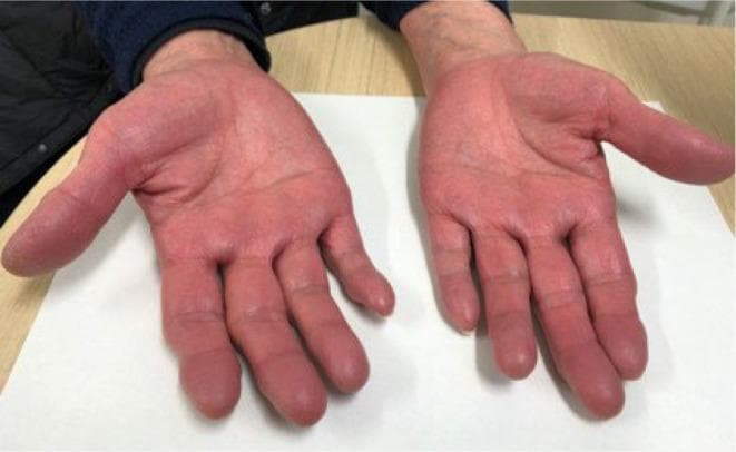 This clinical photograph displays the bilateral palmar surfaces of a patient's hands, illustrating a pronounced, diffuse erythema. The redness is uniform across the palms, thenar and hypothenar eminences, and extends into the distal phalanges of all fingers. The skin appears intact without evidence of scaling, ulceration, or hyperkeratosis. While palmar erythema is frequently associated with chronic liver disease, this specific presentation serves as a clinical sign of hyperviscosity or erythrocytosis, specifically in the context of polycythemia vera. The image demonstrates how the correction of underlying iron deficiency anemia can unmask the plethoric appearance of polycythemia vera as hemoglobin levels rise. This visual is a key educational resource for identifying secondary skin manifestations of myeloproliferative neoplasms and differentiating them from other causes of palmar flushing.