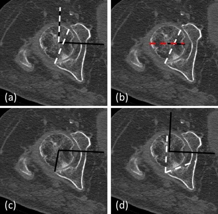 A set of four axial CT scan slices of the hip joint illustrating different methods for measuring acetabular orientation and femoral head coverage. The images show a spherical femoral head articulating with the bony acetabulum. Each panel demonstrates a specific radiological measurement: (a) Acetabular Anteversion Angle (AAA), defined by the angle between the intercapital center line (ICL90) and the anteversion line (AVL) connecting the acetabular lips; (b) Femoral head coverage/roofing, determined by the ratio of the femoral head contained within the AVL to the total femoral diameter; (c) Posterior Acetabular Sector Angle (PASA), measured from the femoral head center to the posterior acetabular wall edge; and (d) Posterior Wall Angle (PWA), determined by the angle between the ICL90 and the tangent to the posterior articular surface. These measurements are used in orthopedic surgery to assess hip stability and the risk of dislocation following Bipolar Hemiarthroplasty (BHA). The imaging modality is clinical CT, focused on musculoskeletal diagnostic assessment.