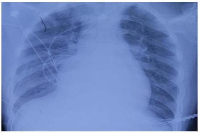 Anterior-posterior (AP) bedside chest radiograph demonstrating significant cardiopulmonary pathology. The cardiac silhouette is markedly enlarged, suggesting cardiomegaly or a pericardial effusion. The lung fields show extensive bilateral opacities, most prominent in the right lung, characterized by a ground-glass appearance and exudative changes consistent with acute pulmonary edema, diffuse alveolar disease, or pneumonia. There is an overall increase in bronchovascular markings and lung texture bilaterally. Several medical devices are visible, including ECG leads and what appears to be an endotracheal tube and central venous catheter, indicating intensive care monitoring. The costophrenic angles are partially obscured by overlying opacities. This image illustrates critical findings often associated with acute respiratory distress syndrome (ARDS) or cardiogenic shock in a clinical setting.