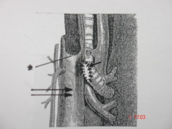 This medical illustration depicts a surgical reinforcement technique following an Ivor Lewis esophagogastrectomy. The diagram shows the intrathoracic positioning of a gastric conduit (marked by a double arrow) in relation to the tracheobronchial tree. An esophagogastric anastomosis is indicated by an asterisk (*). To reinforce a repair of the posterior membranous tracheal wall, the gastric conduit is moved into direct contact with the trachea. Single interrupted nonabsorbable sutures (indicated by a single arrow) are used to secure the gastric wall to the inferior edge of the rigid cartilaginous tracheal rings. This pedagogical image illustrates the use of a vascularized gastric pedicle as a protective flap or 'seal' for tracheal lacerations or patches, demonstrating the anatomical proximity and surgical landmarks relevant to thoracic surgery and complication management in esophagectomy cases.