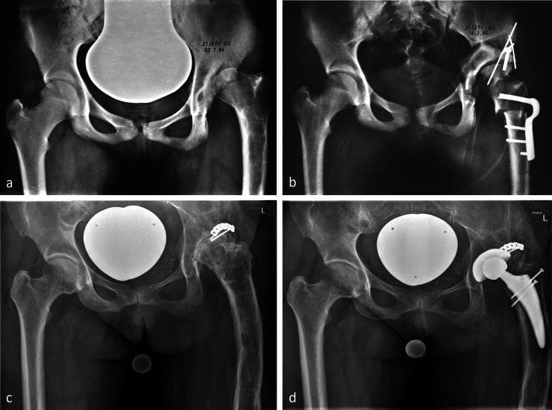 A longitudinal series of four anteroposterior (AP) pelvic radiographs (a–d) demonstrating the 36-year clinical progression and surgical management of a left hip with Proximal Femoral Focal Deficiency (PFFD). Image (a) shows a baseline varus deformity of the proximal femur following a prior intertrochanteric osteotomy. Image (b) illustrates post-surgical results of a periacetabular osteotomy (PAO) combined with intertrochanteric revalgisation, featuring stabilizing hardware including an angled blade plate, screws, and Kirschner wires used to improve femoral head coverage and joint congruity. Image (c) shows the long-term natural history 36 years post-correction, revealing advanced degenerative joint disease (osteoarthritis), joint space loss, and subchondral sclerosis, with hardware from a subsequent posterior shelf procedure still visible. Image (d) displays the final state after Total Hip Replacement (THR), showing a well-positioned prosthetic acetabular cup and femoral stem, restoring anatomical alignment. This series serves as a pedagogical timeline for joint-preserving osteotomies versus eventual arthroplasty in complex pediatric hip deformities.