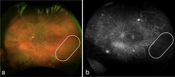 This figure presents two wide-field fundus images of a patient with proliferative diabetic retinopathy (PDR) and diabetic macular edema (DME). Image (a) is an ultra-widefield pseudocolor fundus photograph. It displays the characteristic orange-red retinal hue with superimposed green circles representing the ETDRS (Early Treatment Diabetic Retinopathy Study) grid for macular assessment. A white oval in the temporal periphery highlights an area of 'vessel whitening,' where the retinal vasculature appears pale and attenuated. Image (b) is a fundus fluorescein angiogram (FFA) of the same eye. In the region corresponding to the white oval, there is a clear area of hypofluorescence, indicating capillary non-perfusion and vascular filling defects. Additionally, the FFA reveals multiple punctate hyperfluorescent spots across the mid-periphery and posterior pole, consistent with microaneurysms or neovascularization. This comparison demonstrates the clinical significance of peripheral retinal vessel whitening as a marker for underlying ischemic non-perfusion in diabetic patients, facilitating diagnostic classification of disease severity.