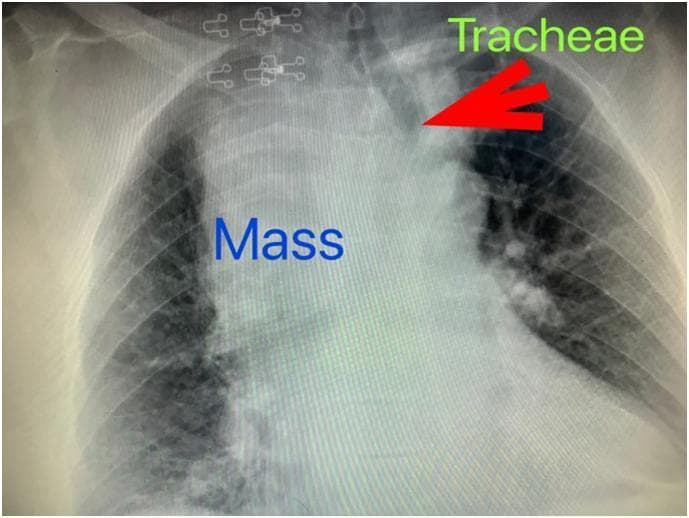 A posterior-anterior (PA) chest x-ray demonstrating significant pathology in the superior and middle mediastinum. The most prominent finding is a severely widened mediastinum, characterized by a large, well-defined radiopaque mass occupying the upper and middle thoracic cavity. This mass is causing a marked mass effect, resulting in the significant deviation of the trachea to the left of the midline, as indicated by the labeled red arrow. The mass displays a radiographic appearance consistent with a retrosternal goiter, extending from the cervical region into the thoracic inlet. Metallic surgical clips are visible in the upper right cervical area, suggesting previous surgery. The lung fields appear relatively clear, though the cardiac silhouette is partially obscured by the large mediastinal opacity. This diagnostic image is used to illustrate the complications of large mediastinal masses, such as airway compression and displacement, relevant for pulmonology, endocrine surgery, and critical care education.