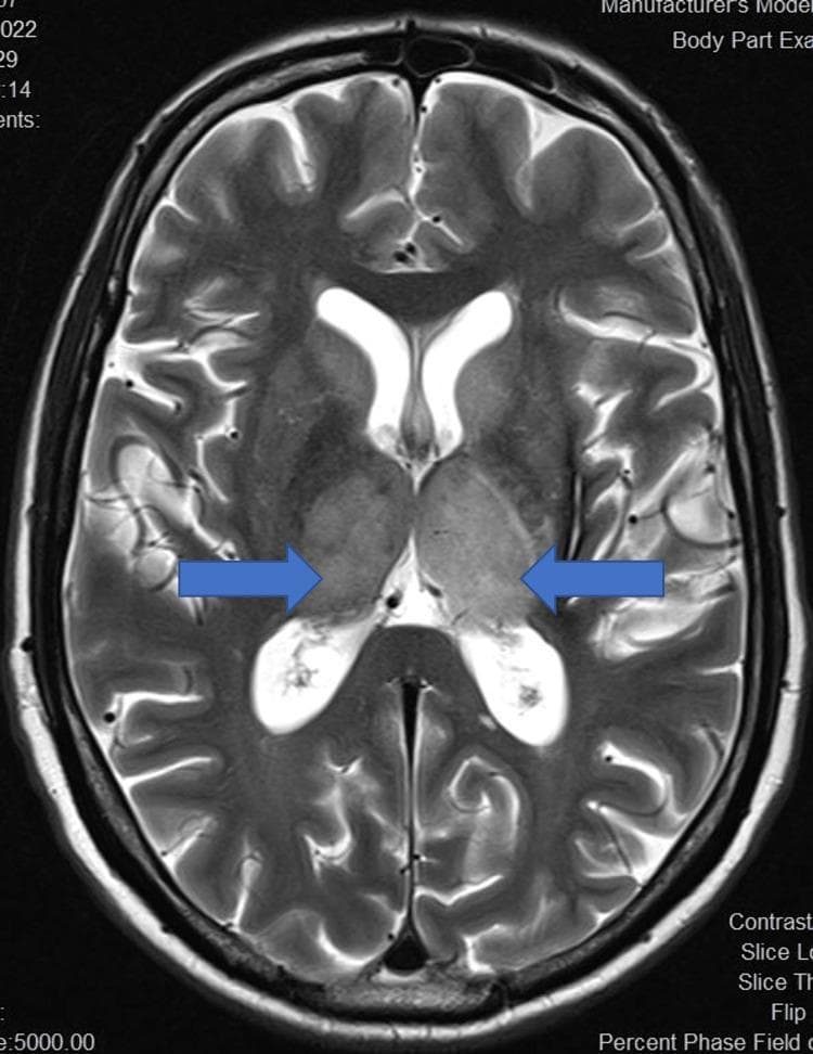 This diagnostic image is an axial T2-weighted magnetic resonance imaging (MRI) scan of the human brain. The focal pathology is highlighted by blue arrows, demonstrating bilateral, symmetrical enlargement and T2 hyperintensity of the thalami. These findings are characteristic of deep gray matter involvement in neuroinflammatory or infectious conditions, such as Japanese Encephalitis. The increased signal intensity within the thalami is distinct against the surrounding darker brain parenchyma. Other visible anatomical structures include the frontal and occipital horns of the lateral ventricles, which exhibit normal high-signal cerebrospinal fluid (CSF), and the cerebral cortex with clearly defined gyri and sulci. The imaging demonstrates a classic presentation of bilateral thalamic lesions, a key diagnostic feature for differentiating viral encephalitides and certain metabolic disorders. The educational value of this image lies in its clear demonstration of thalamic edema and signal changes on a standard T2 sequence.