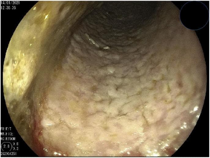 This diagnostic image is an upper gastrointestinal endoscopy photograph of the esophageal lumen. The image demonstrates a hallmark presentation of esophageal candidiasis (fungal infection). The esophageal mucosa is extensively covered by thick, whitish, cottage-cheese-like plaques. These deposits are confluent, merging to form a continuous, irregular layer that obscures the underlying vascular architecture of the esophageal wall. The lumen appears slightly dilated, and the texture of the plaque-covered mucosa is rough and granular. In areas where the white coating is less dense, there is evidence of erythema, suggesting underlying mucosal inflammation. This visual finding is classically associated with opportunistic fungal infections in immunocompromised patients or those with esophageal stasis. The clinical significance lies in the recognition of confluent exudative plaques as a diagnostic marker for infectious esophagitis, requiring further histopathological or microbiological confirmation via biopsy or brushings.