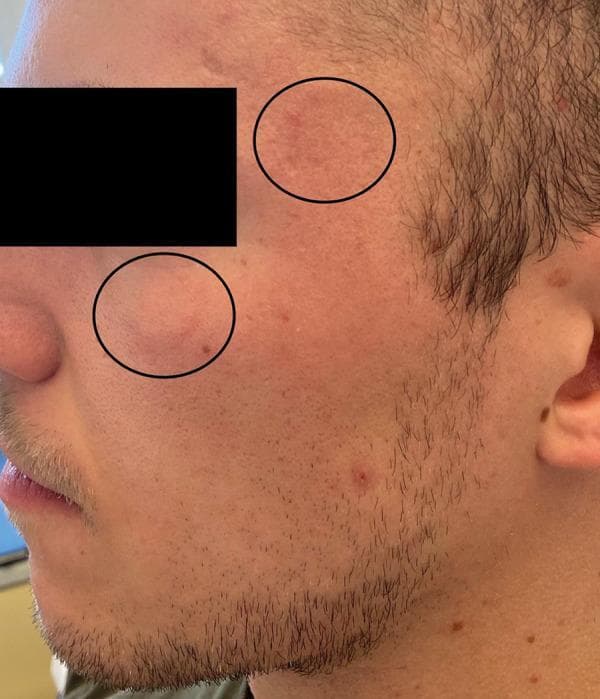 This clinical photograph displays a lateral view of a male patient's face, demonstrating a localized allergic reaction during a double-blind placebo-controlled food challenge (DBPCFC). Two black circles highlight facial wheals (urticaria) located on the upper cheek/zygomatic region and the mid-cheek near the nasolabial fold. These wheals appear as edematous, erythematous, and slightly elevated plaques. The lesion on the upper cheek shows a more irregular border and uneven texture, while the lower lesion is more discrete and circular. The surrounding skin also exhibits scattered, smaller erythematous papules and blemishes. This image illustrates the dermatological manifestations of an immediate IgE-mediated hypersensitivity reaction to cow's milk occurring despite omalizumab therapy. It serves as a pedagogical example for identifying facial urticaria and monitoring clinical responses during allergen provocation tests in an immunology or allergy-immunology educational context.