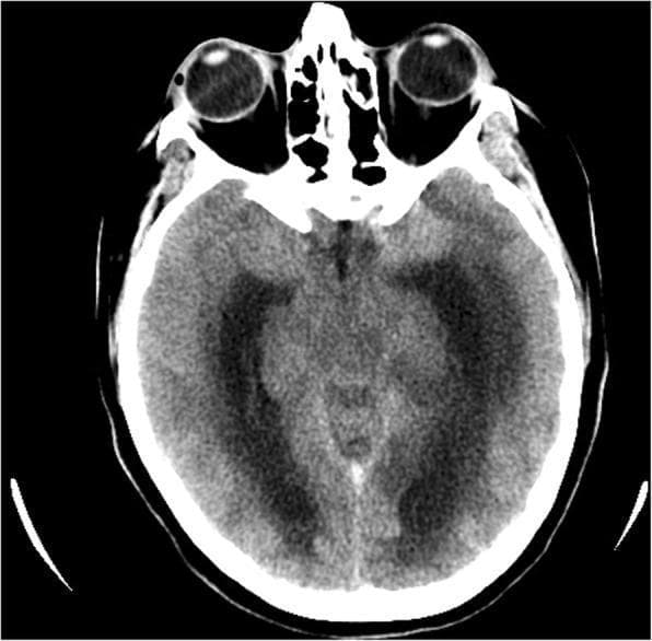 Axial non-contrast computed tomography (CT) scan of the brain at the level of the basal cisterns and midbrain. The image demonstrates a right-sided external ventricular drain (EVD) with its distal tip positioned within the right lateral ventricle. Significant clinical findings include diffuse cerebral edema characterized by global loss of gray-white matter differentiation and effacement of the cortical sulci. There is evidence of secondary hydrocephalus with enlargement of the temporal horns of the lateral ventricles. Signs of increased intracranial pressure are present, notably downward transtentorial herniation as indicated by the compression and effacement of the perimesencephalic cisterns. This imaging is characteristic of critical neurologic deterioration often associated with complications from cerebral venous thrombosis (CVT) or severe intracranial hypertension. The diagnostic focus is on evaluating the efficacy of EVD placement in relieving acute obstructive hydrocephalus and monitoring for signs of impending herniation syndromes.