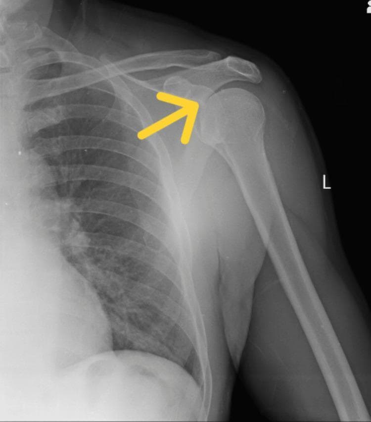 This diagnostic image is an anteroposterior (AP) X-ray of the left shoulder girdle. It illustrates the primary anatomical structures of the glenohumeral joint, including the humerus, scapula (acromion process and glenoid fossa), and clavicle, with the adjacent rib cage and lung field visible in the medial aspect. The radiograph demonstrates a classic anterior shoulder dislocation, characterized by the displacement of the humeral head anteriorly and inferiorly relative to the glenoid fossa. A yellow annotation arrow is positioned at the vacated glenoid rim, highlighting the misalignment where the humeral head has lost its normal anatomical articulation. The bone density appears preserved, with no immediate evidence of associated fractures such as a Hill-Sachs or Bankart lesion visible in this view. This image serves as a clinical teaching tool for medical students and clinicians to identify acute traumatic joint instability and the radiographic presentation of glenohumeral misalignment.