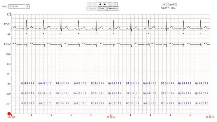 This diagnostic image displays a multi-channel electrocardiogram (ECG) tracing on a standard red-grid background, utilized for cardiac monitoring and arrhythmia analysis. The top channel, labeled 'ECG1', shows a regular sinus rhythm characterized by distinct P waves, narrow QRS complexes, and upright T waves. Below it, a marker line 'atr' indicates beat detections. The second tracing, 'ECG2', provides a different lead perspective with inverted QRS complexes. The bottom third of the image contains horizontal annotation rows labeled 'pu', 'pu0', and 'pu1', which feature repetitive textual markers like '(p)', '(+)', and '(t)' aligned with the cardiac cycles above. These annotations serve as algorithmic labels for specific components of the ECG waveform (P wave, QRS onset, and T wave termination). The overall display represents data extraction from a clinical database, likely the PhysioNet QT Database, often used for training machine learning models in automated supraventricular arrhythmia detection and cardiac signal classification.